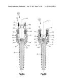 Revision Connector For Spinal Constructs diagram and image