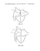 DEVICES AND METHODS FOR TREATING HEART FAILURE diagram and image