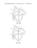 DEVICES AND METHODS FOR TREATING HEART FAILURE diagram and image