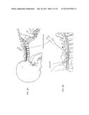 INTRADURAL ENDOSCOPE diagram and image