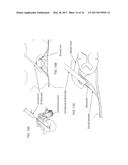 INTRADURAL ENDOSCOPE diagram and image