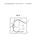 TREATMENT APPARATUS FOR A SUBRETINAL INJECTION AND METHOD FOR ASSISTING IN     A SUBRETINAL INJECTION diagram and image