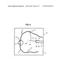 TREATMENT APPARATUS FOR A SUBRETINAL INJECTION AND METHOD FOR ASSISTING IN     A SUBRETINAL INJECTION diagram and image