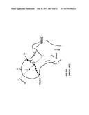 Femoral Heads, Mobile Inserts, Acetabular Components, and Modular     Junctions for Orthopedic Implants and Methods of Using Femoral Heads,     Mobile Insets, Acetabular Components, and Modular Junctions for     Orthopedic Implants diagram and image