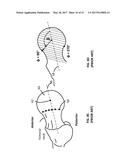 Femoral Heads, Mobile Inserts, Acetabular Components, and Modular     Junctions for Orthopedic Implants and Methods of Using Femoral Heads,     Mobile Insets, Acetabular Components, and Modular Junctions for     Orthopedic Implants diagram and image