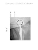 Femoral Heads, Mobile Inserts, Acetabular Components, and Modular     Junctions for Orthopedic Implants and Methods of Using Femoral Heads,     Mobile Insets, Acetabular Components, and Modular Junctions for     Orthopedic Implants diagram and image