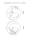 Femoral Heads, Mobile Inserts, Acetabular Components, and Modular     Junctions for Orthopedic Implants and Methods of Using Femoral Heads,     Mobile Insets, Acetabular Components, and Modular Junctions for     Orthopedic Implants diagram and image