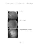 TREATMENT OF FAMILIAL EXUDATIVE VITREORETINOPATHY THROUGH S1PR2 INHIBITION diagram and image