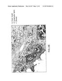 AUTOMATIC GLANDULAR AND TUBULE DETECTION IN HISTOLOGICAL GRADING OF BREAST     CANCER diagram and image