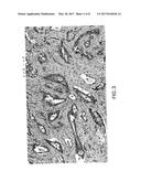 AUTOMATIC GLANDULAR AND TUBULE DETECTION IN HISTOLOGICAL GRADING OF BREAST     CANCER diagram and image