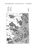 AUTOMATIC GLANDULAR AND TUBULE DETECTION IN HISTOLOGICAL GRADING OF BREAST     CANCER diagram and image