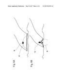 SURGICAL APPARATUS, METHOD FOR USING THE SURGICAL APPARATUS AND SUTURE     METHOD diagram and image