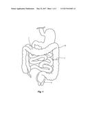 INSTRUMENTS AND METHODS FOR TREATING ULCERATIVE COLITIS AND OTHER     INFLAMMATORY BOWEL DISEASES diagram and image