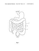 APPARATUSES, SYSTEMS AND METHODS FOR TREATING ULCERATIVE COLITIS AND OTHER     INFLAMMATORY BOWEL DISEASES diagram and image