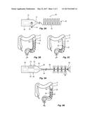 APPARATUSES, SYSTEMS AND METHODS FOR TREATING ULCERATIVE COLITIS AND OTHER     INFLAMMATORY BOWEL DISEASES diagram and image