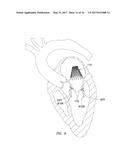 MITRAL VALVE INVERSION PROSTHESES diagram and image