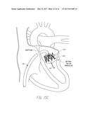 MITRAL VALVE INVERSION PROSTHESES diagram and image