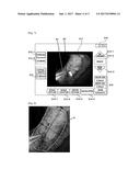 METHOD FOR MEASURING SIZE OF LESION WHICH IS SHOWN BY ENDOSCOPE, AND     COMPUTER READABLE RECORDING MEDIUM diagram and image