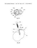 IMPLANT PLACEMENT SYSTEMS, DEVICES AND METHODS diagram and image