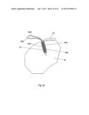 IMPLANT PLACEMENT SYSTEMS, DEVICES AND METHODS diagram and image