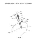 IMPLANT PLACEMENT SYSTEMS, DEVICES AND METHODS diagram and image