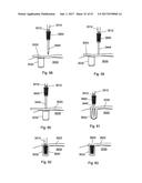 IMPLANT PLACEMENT SYSTEMS, DEVICES AND METHODS diagram and image