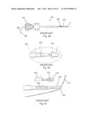 IMPLANT PLACEMENT SYSTEMS, DEVICES AND METHODS diagram and image