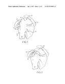 SUTURE SLEEVE PATCH AND METHODS OF DELIVERY WITHIN AN EXISTING     ARTHROSCOPIC WORKFLOW diagram and image