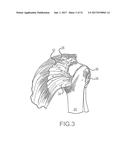 SUTURE SLEEVE PATCH AND METHODS OF DELIVERY WITHIN AN EXISTING     ARTHROSCOPIC WORKFLOW diagram and image