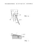 SUTURE SLEEVE PATCH AND METHODS OF DELIVERY WITHIN AN EXISTING     ARTHROSCOPIC WORKFLOW diagram and image