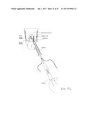 SUTURE SLEEVE PATCH AND METHODS OF DELIVERY WITHIN AN EXISTING     ARTHROSCOPIC WORKFLOW diagram and image