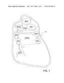 CATHETERS, CATHETER SYSTEMS, AND METHODS FOR PUNCTURING THROUGH A TISSUE     STRUCTURE AND ABLATING A TISSUE REGION diagram and image