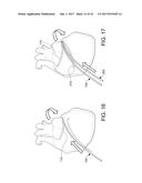 CATHETERS, CATHETER SYSTEMS, AND METHODS FOR PUNCTURING THROUGH A TISSUE     STRUCTURE AND ABLATING A TISSUE REGION diagram and image