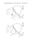 CATHETERS, CATHETER SYSTEMS, AND METHODS FOR PUNCTURING THROUGH A TISSUE     STRUCTURE AND ABLATING A TISSUE REGION diagram and image