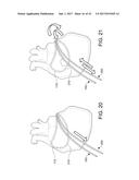 CATHETERS, CATHETER SYSTEMS, AND METHODS FOR PUNCTURING THROUGH A TISSUE     STRUCTURE AND ABLATING A TISSUE REGION diagram and image