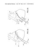 CATHETERS, CATHETER SYSTEMS, AND METHODS FOR PUNCTURING THROUGH A TISSUE     STRUCTURE AND ABLATING A TISSUE REGION diagram and image