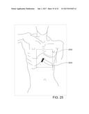 CATHETERS, CATHETER SYSTEMS, AND METHODS FOR PUNCTURING THROUGH A TISSUE     STRUCTURE AND ABLATING A TISSUE REGION diagram and image