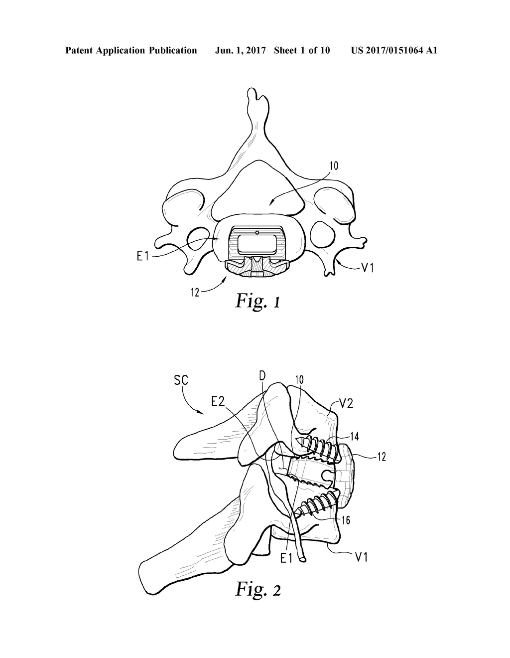 INTERBODY DEVICE AND PLATE FOR SPINAL STABILIZATION AND INSTRUMENTS FOR     POSITIONING SAME - diagram, schematic, and image 02