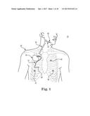 PERCUTANEOUS ACCESS FOR SYSTEMS AND METHODS OF TREATING SLEEP-RELATED     DISORDERED BREATHING diagram and image