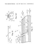 PERCUTANEOUS ACCESS FOR SYSTEMS AND METHODS OF TREATING SLEEP-RELATED     DISORDERED BREATHING diagram and image