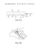 PERCUTANEOUS ACCESS FOR SYSTEMS AND METHODS OF TREATING SLEEP-RELATED     DISORDERED BREATHING diagram and image