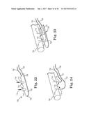 PERCUTANEOUS ACCESS FOR SYSTEMS AND METHODS OF TREATING SLEEP-RELATED     DISORDERED BREATHING diagram and image