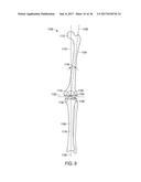 CUT GUIDE ATTACHMENT FOR USE IN TIBIAL PROSTHESIS SYSTEMS diagram and image