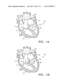 Prosthetic Tissue Valves and Methods for Anchoring Same to Cardiovascular     Structures diagram and image