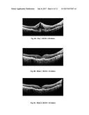 METHOD OF TREATING CONDITIONS OF THE EYE WITH AN ANTI-VEGF DARPIN diagram and image
