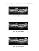 METHOD OF TREATING CONDITIONS OF THE EYE WITH AN ANTI-VEGF DARPIN diagram and image