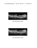 METHOD OF TREATING CONDITIONS OF THE EYE WITH AN ANTI-VEGF DARPIN diagram and image