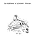 MEDICAL APPARATUSES AND RELATED METHODS FOR INTRANASAL FLUID DELIVERY diagram and image