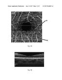 AUTOMATIC THREE-DIMENSIONAL SEGMENTATION METHOD FOR OCT AND DOPPLER OCT     ANGIOGRAPHY diagram and image