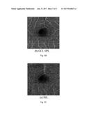 AUTOMATIC THREE-DIMENSIONAL SEGMENTATION METHOD FOR OCT AND DOPPLER OCT     ANGIOGRAPHY diagram and image